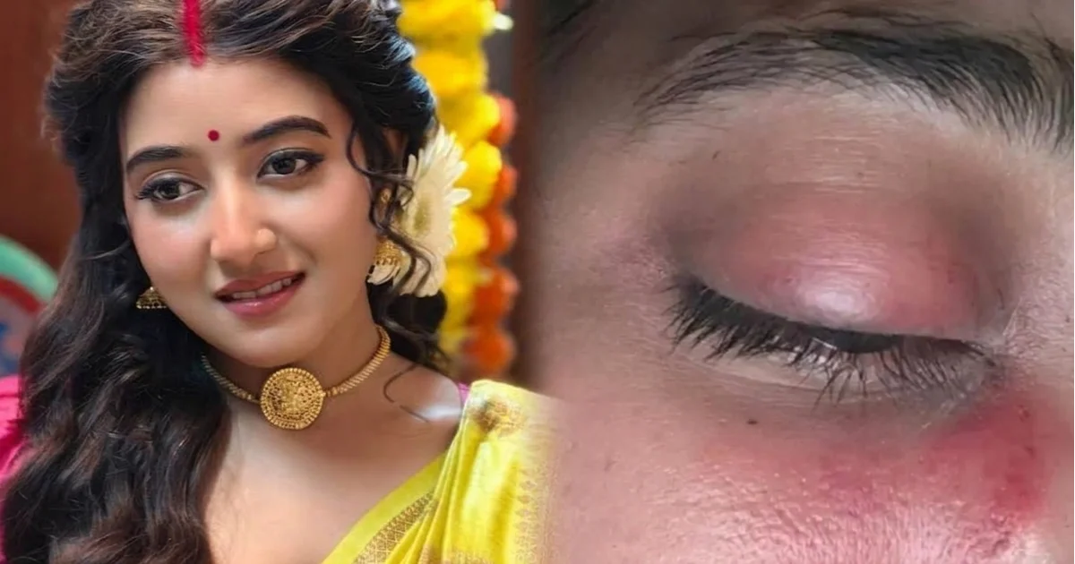 একটুর জন্য বেঁচে গিয়েছে দৃষ্টিশক্তি! র*ক্ত জমাট বেঁধে ফুলে গিয়েছে চোখ, শুটিং করতে গিয়ে ভয়ঙ্ক'র চোট পেলেন আরাত্রিকা মাইতি! উদ্বিগ্ন অনুরাগীরা, এখন কেমন আছেন প্রিয় অভিনেত্রী? 1 aratrika maity serious eye injury during shooting actress health update